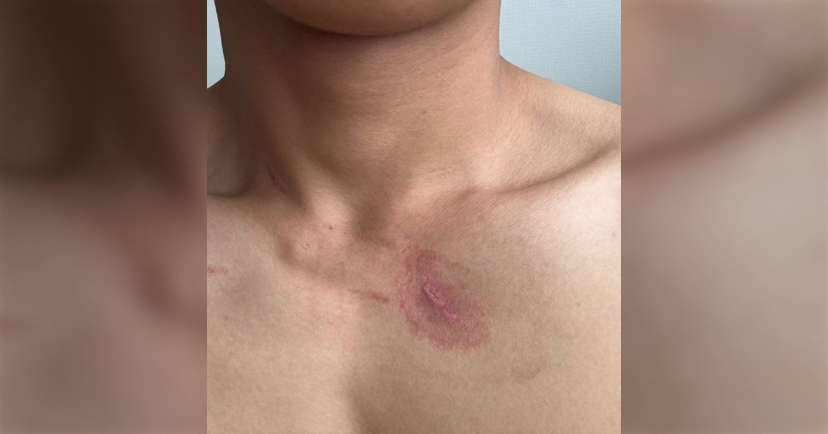 【虫画像注意】ポスト主の身体に火傷のような症状、痛みも痒みも引いたが1週間以上経過してもまだ痕が残る…部屋で見つけたのはアオバアリガタハネカクシだった→いろんな所にいるので注意