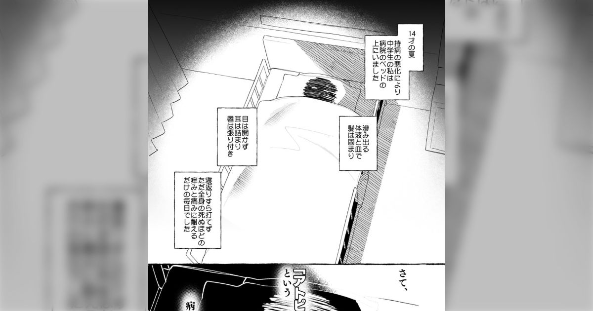 かなり重度のアトピー性皮膚炎に悩まされていたが人権を金で買った話「先進医療万歳」「デュピクセントの効きは劇的」