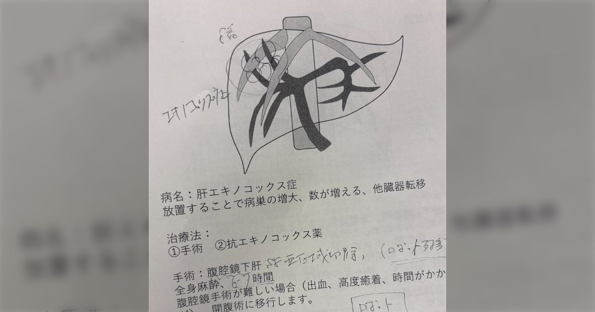 【長谷川、肝臓で虫を飼育してるってよ】健康診断のエコー検査で100mm超えの嚢胞が発見、その後、肝エキノコックス症だと判明した話… 発見が遅れていたら、死ぬところだった
