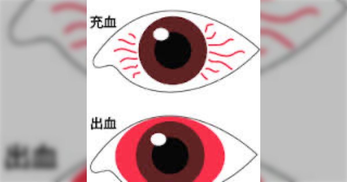 眼の充血と、眼の出血は別物です。 - posfie